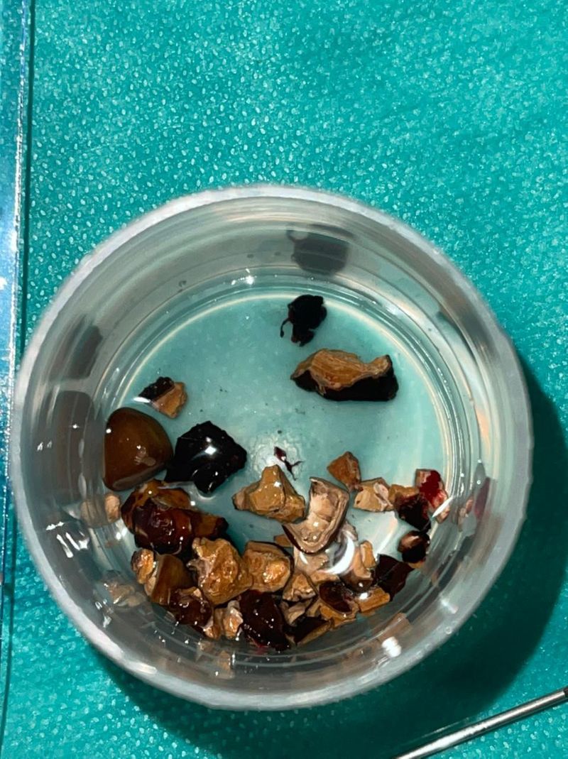 Dubai: Doctors perform a rare surgery and save life of patient with giant kidney stone